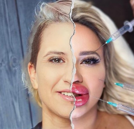 Jessy Bunny Plastic Surgery Transforming Into A Human Barbie Doll