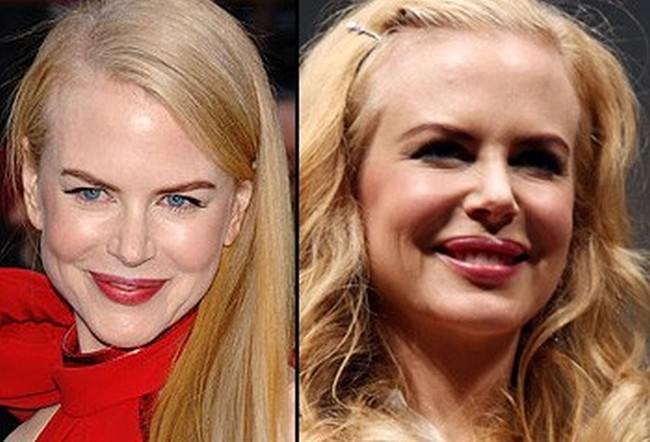Nicole Kidman Plastic Surgery Photos Before Amp After Surgery4 Nicole Kidman Plastic Surgery Photos Before Amp After Surgery4